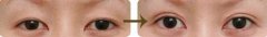 雙眼皮失敗的原因 修復(fù)失敗雙眼皮方法