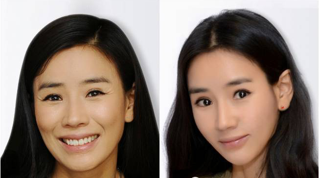 注射瘦臉注射美容多少錢 注射瘦臉注射美容前后對比圖