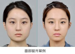 【面部注射物取出】注射在面部的填充物可以取出嗎? 【面部注射物取出】注射在面部的填充物可以取出嗎?