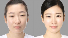 武漢下頜角削骨整形手術(shù)價(jià)格 武漢下頜角削骨整形手術(shù)前后對(duì)比果圖 武漢下頜角削骨整形手術(shù)價(jià)格 武漢下頜角削骨整形手術(shù)前后對(duì)比果圖