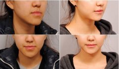 下頜角整形手術(shù)需要住院?jiǎn)?下頜角整形手術(shù)術(shù)后護(hù)理 下頜角整形手術(shù)需要住院?jiǎn)?下頜角整形手術(shù)術(shù)后護(hù)理