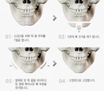 下頜角削骨整形手術(shù)價(jià)格 下頜角截骨整容手術(shù)術(shù)后護(hù)理 下頜角削骨整形手術(shù)價(jià)格 下頜角截骨整容手術(shù)術(shù)后護(hù)理