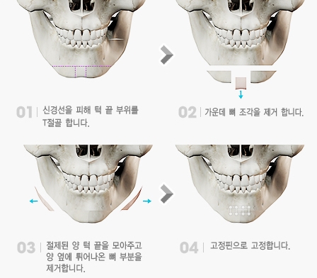 下頜角削骨整形手術(shù)價(jià)格 下頜角截骨整容手術(shù)術(shù)后護(hù)理