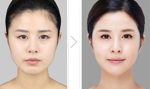 下頜角削骨整形手術(shù)價(jià)格 下頜角截骨整容手術(shù)術(shù)后護(hù)理