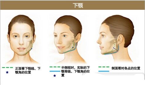 寬下頜角整形手術(shù) 下頜角肥大矯正手術(shù)