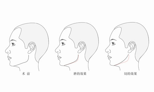 做下頜角整形術(shù)價(jià)格 下頜角整形術(shù)全過程