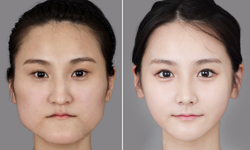 做下頜角整形術(shù)價(jià)格 下頜角整形術(shù)全過程