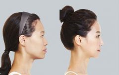 下頜角截骨整形大概多少錢 下頜角截骨整形術(shù)全過(guò)程 下頜角截骨整形大概多少錢 下頜角截骨整形術(shù)全過(guò)程