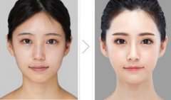 杭州下頜角截骨整形手術(shù)多少錢(qián)