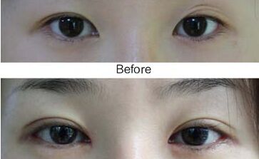 雙眼皮修復(fù)手術(shù)適應(yīng)癥,雙眼皮修復(fù)術(shù)后注意