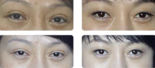 雙眼皮修復(fù)手術(shù)適應(yīng)癥,雙眼皮修復(fù)術(shù)后注意