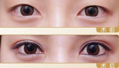雙眼皮修復(fù)價(jià)格貴嗎 雙眼皮修復(fù)多少錢(qián)