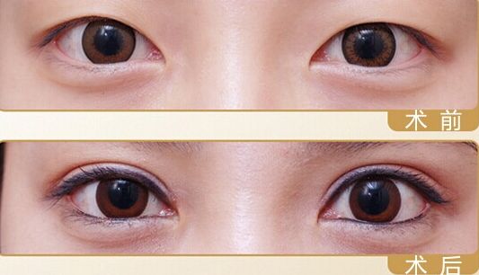 雙眼皮修復(fù)價格貴嗎 雙眼皮修復(fù)多少錢