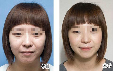 簡單有去眼袋的方法有哪些