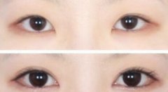 雙眼皮失敗了怎么辦 雙眼皮失敗后如何修復(fù)
