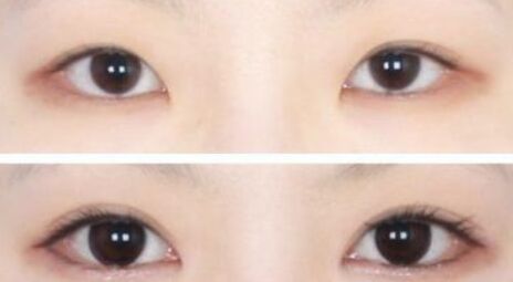 雙眼皮失敗了怎么辦 雙眼皮失敗后如何修復(fù)
