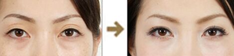 雙眼皮失敗了怎么辦 雙眼皮失敗后如何修復(fù)