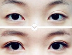 埋線雙眼皮失敗了怎么辦 埋線雙眼皮失敗修復(fù)