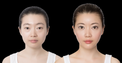 下頜角整形果怎么樣 下頜角整形對(duì)比照片 下頜角整形果怎么樣 下頜角整形對(duì)比照片