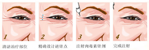 注射瘦臉注射美容