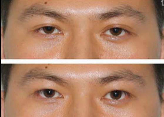 有沒(méi)有雙眼皮變單眼皮的方法 怎樣把雙眼皮變成單眼皮