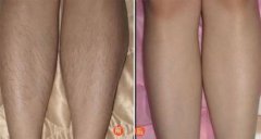 冰點脫毛果真的那么好嗎 冰點脫毛果圖