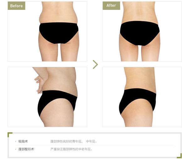 腰腹吸脂術(shù)