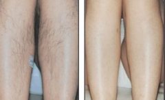 激光脫毛術(shù)前術(shù)后注意事項