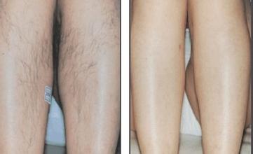 激光脫毛術(shù)前術(shù)后注意事項(xiàng)