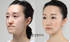 女人尖下頜角整形美麗新標(biāo)準(zhǔn) 女人尖下頜角整形美麗新標(biāo)準(zhǔn)