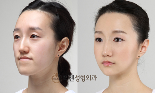 女人尖下頜角整形美麗新標準