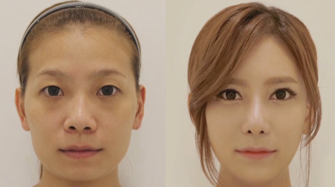 女人尖下頜角整形美麗新標準