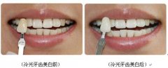 冷光美白和洗牙的區(qū)別