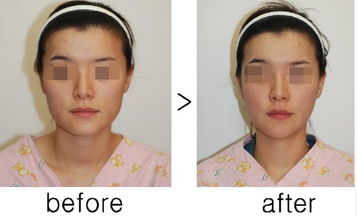 下頜角整形成好嗎