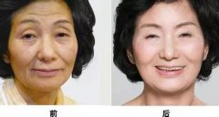 臉部皮膚松弛下垂怎么辦