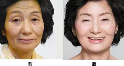 臉部皮膚松弛下垂怎么辦