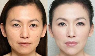 臉部皮膚松弛下垂怎么辦