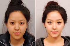 下頜角整形恢復(fù)期多久 下頜角整形案例對比照片 下頜角整形恢復(fù)期多久 下頜角整形案例對比照片