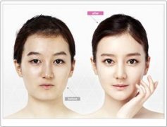 女人尖下頜角整形果怎么樣 女人尖下頜角整形果怎么樣
