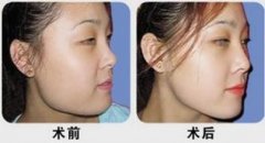 尖下頜角整形介紹 尖下頜角整形介紹