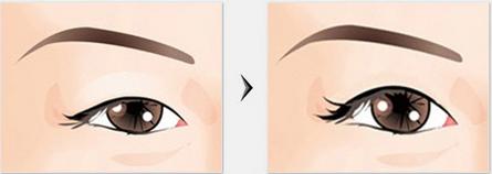 重慶眼部整形美容手術(shù)失敗修復(fù)多少錢