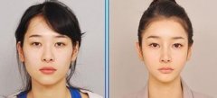 女性尖下頜角整形注意事項 女性尖下頜角整形注意事項