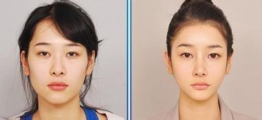 女性尖下頜角整形注意事項(xiàng)