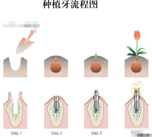 種植牙多少錢一顆