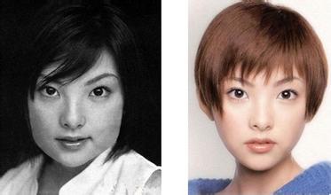 下頜角截骨手術后遺癥