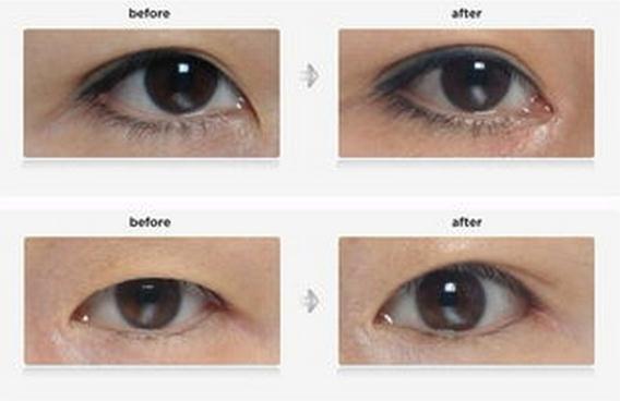 西安開眼角會(huì)不會(huì)影響到視力？