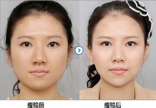 北京注射瘦臉B****多少錢