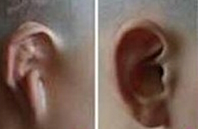 選擇隱耳整形有什么優(yōu)勢呢？