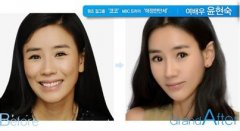 肥胖下頜角整形注意事項 肥胖下頜角整形注意事項