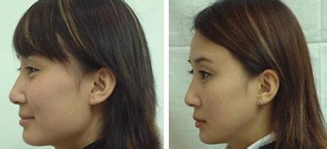 肥胖下頜角整形多少錢(qián)